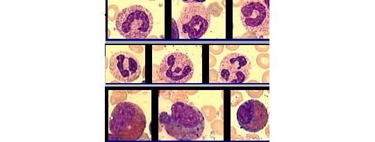 Фото 2 КЛИН1-ЦМ - пакет программ комплекса микроскопии МЕКОС-Ц2 для гематологии - АРМ врача-гематолога 2014